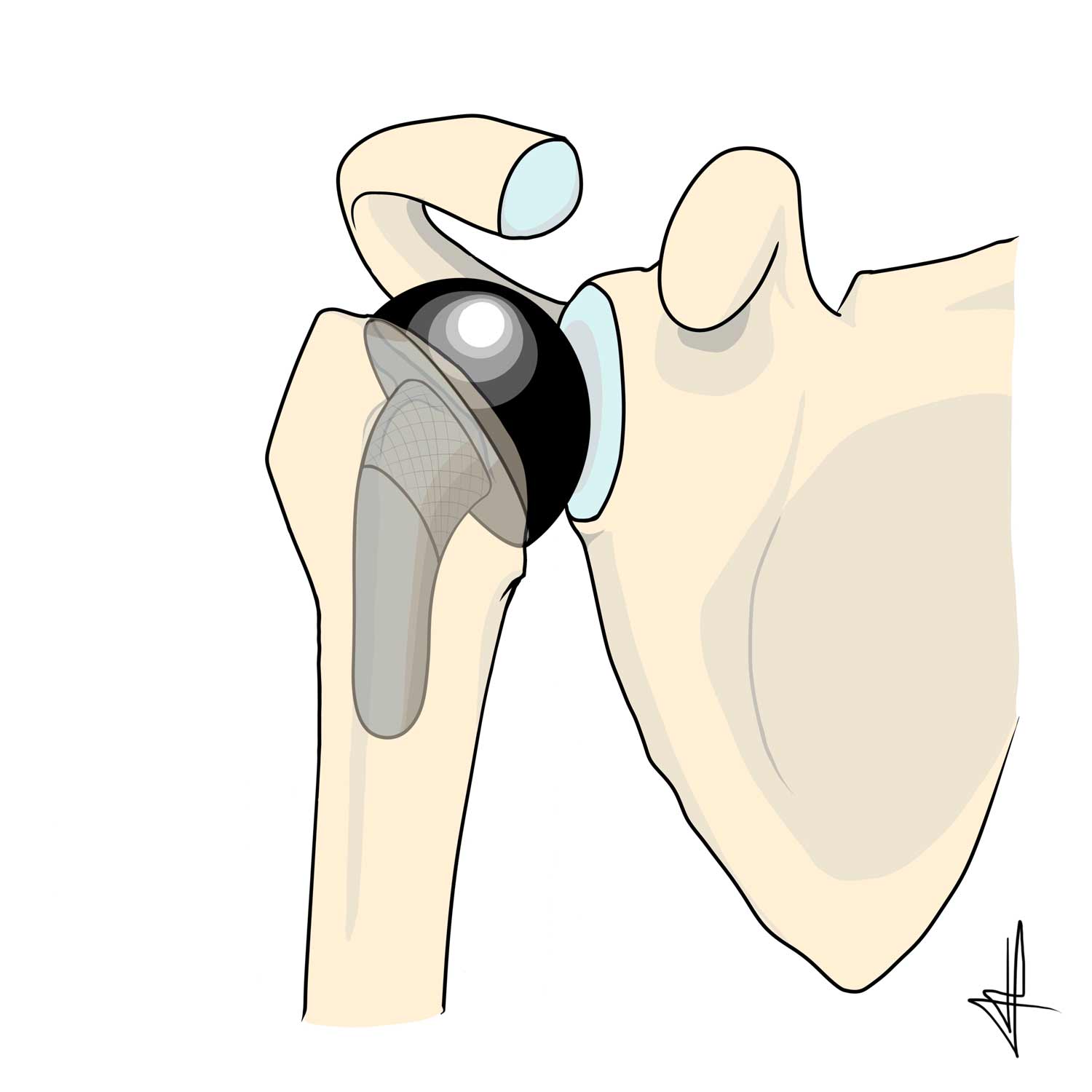 Hemi-PTE-prothese-epaule-3