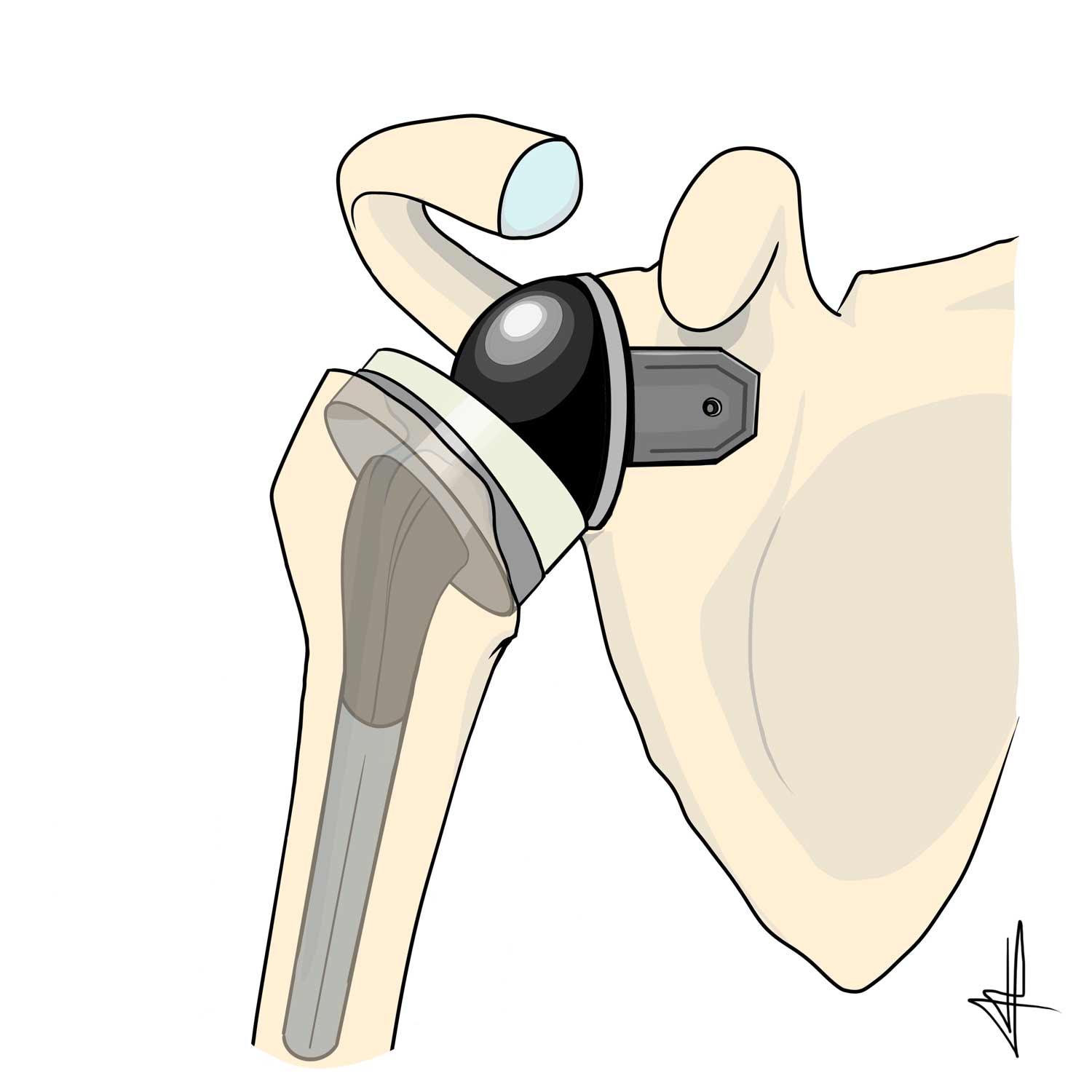 PTEA-prothese-epaule-4