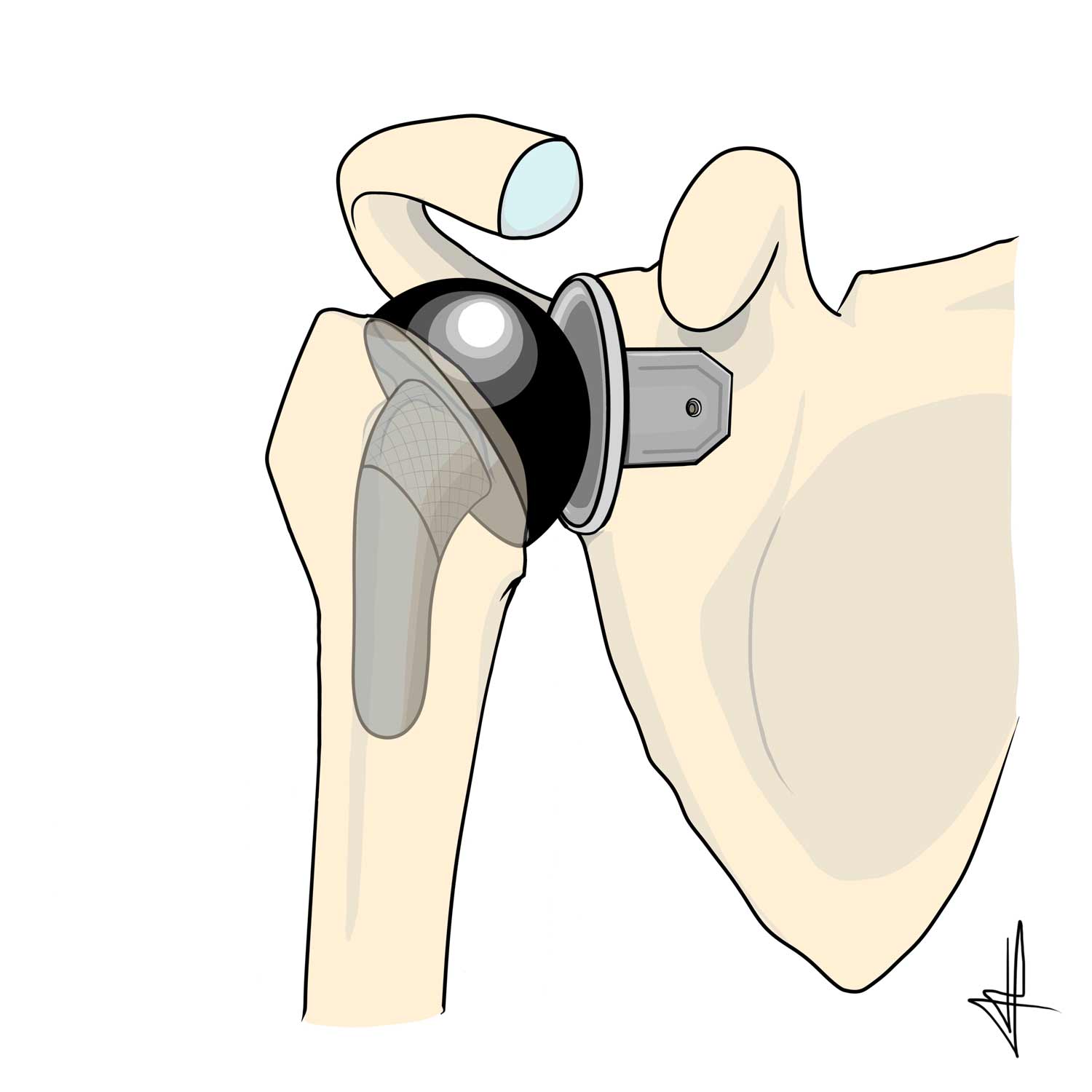 PTEA-prothese-epaule4